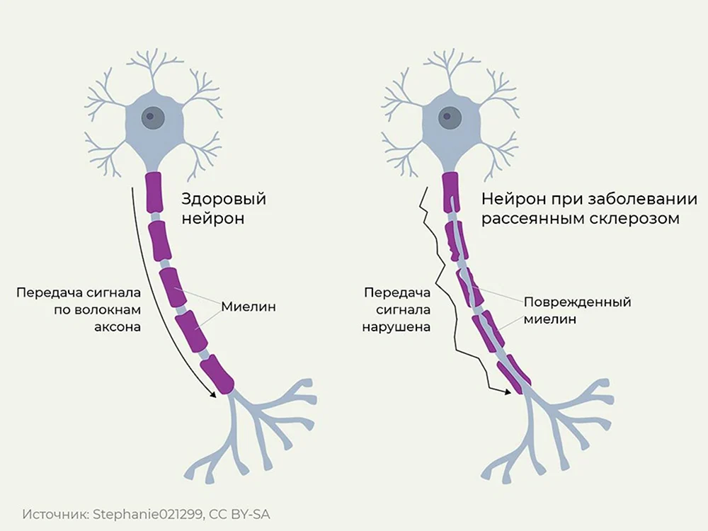 Рассеянный склероз нервная клетка